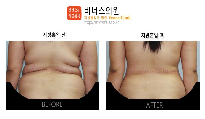 복부지방흡입2.jpg
