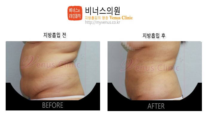 복부지방흡입1.jpg