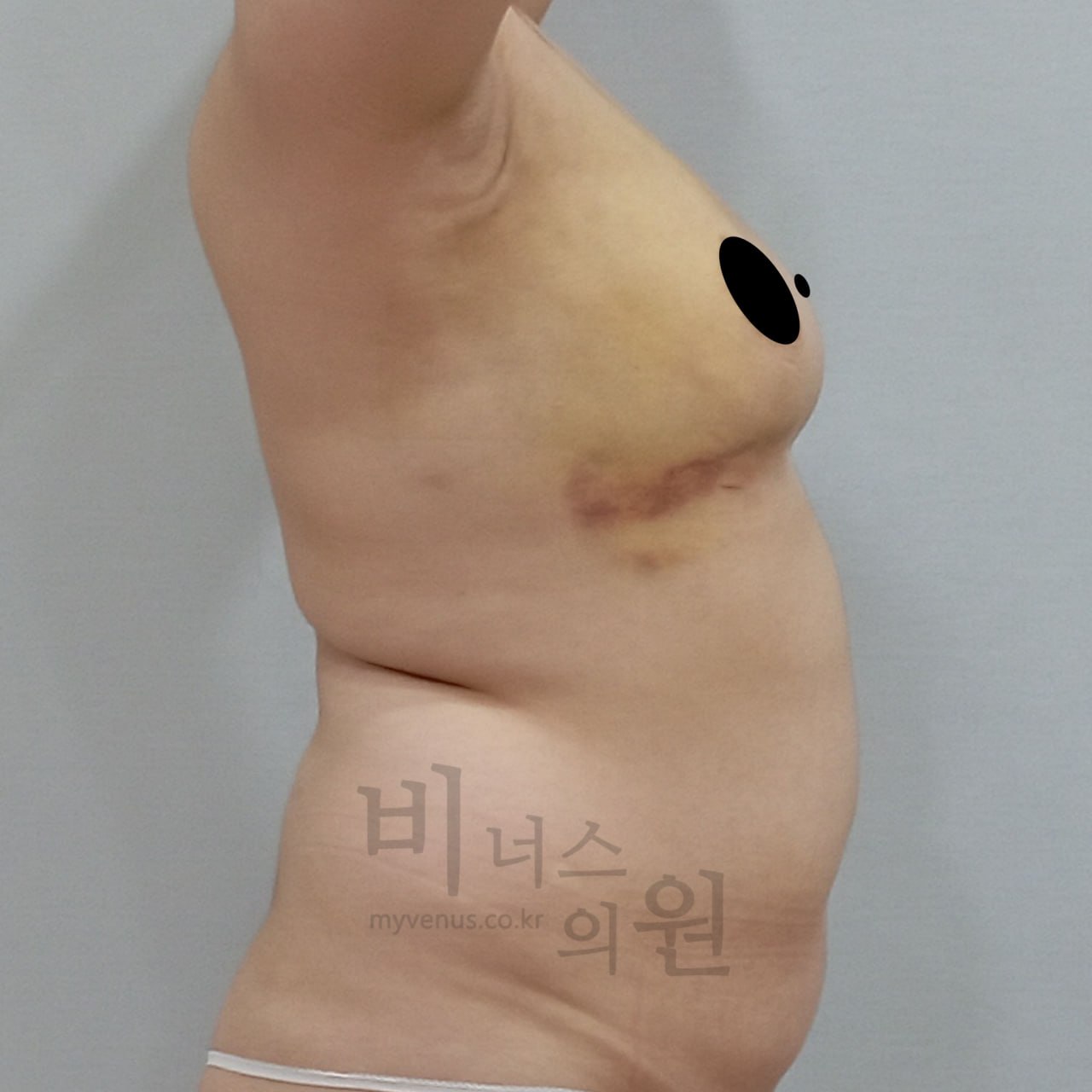 가슴축소 지방흡입 수술 후 측면 비너스의원