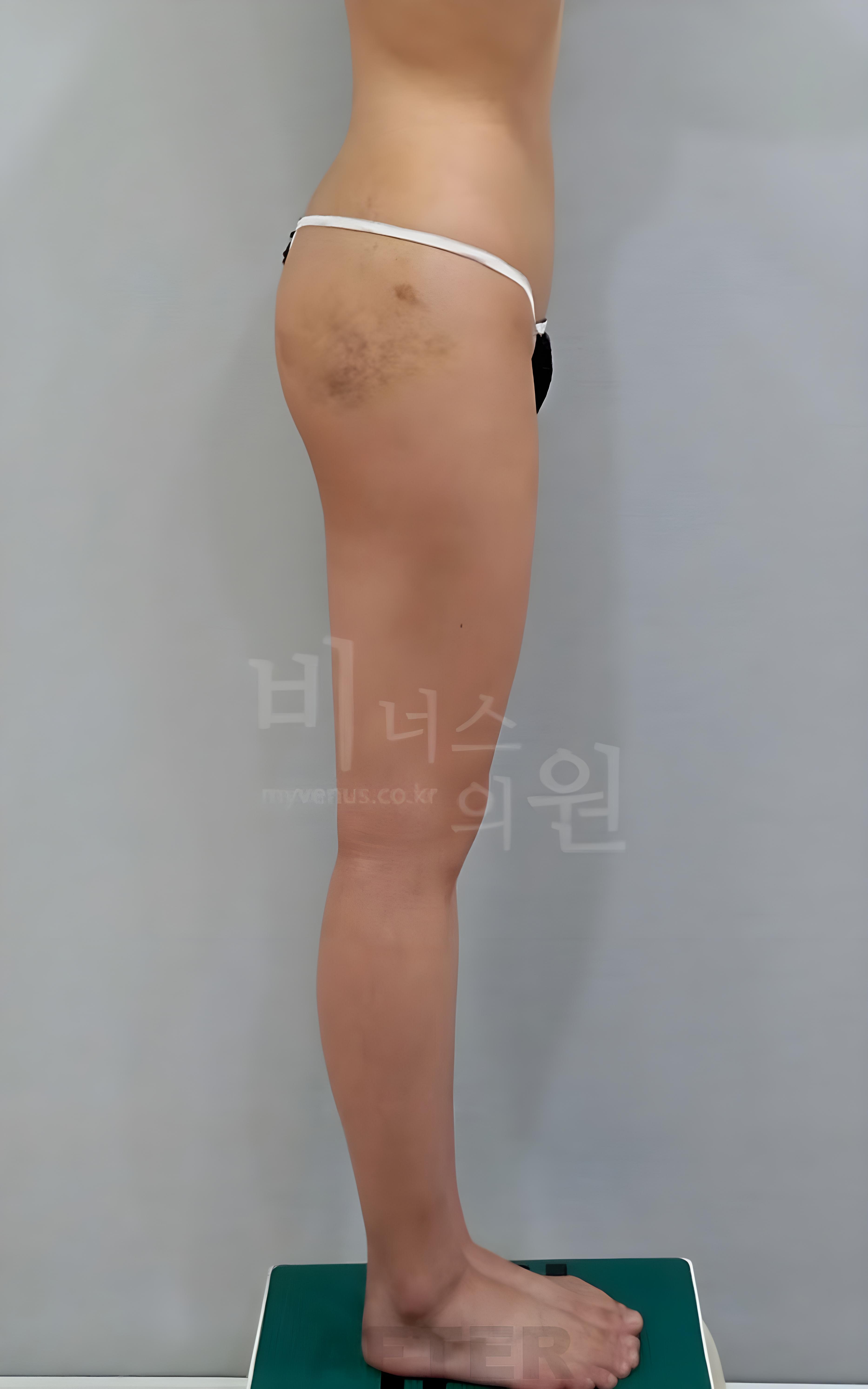 엉덩이축소 지방흡입 수술 후 측면 비너스의원