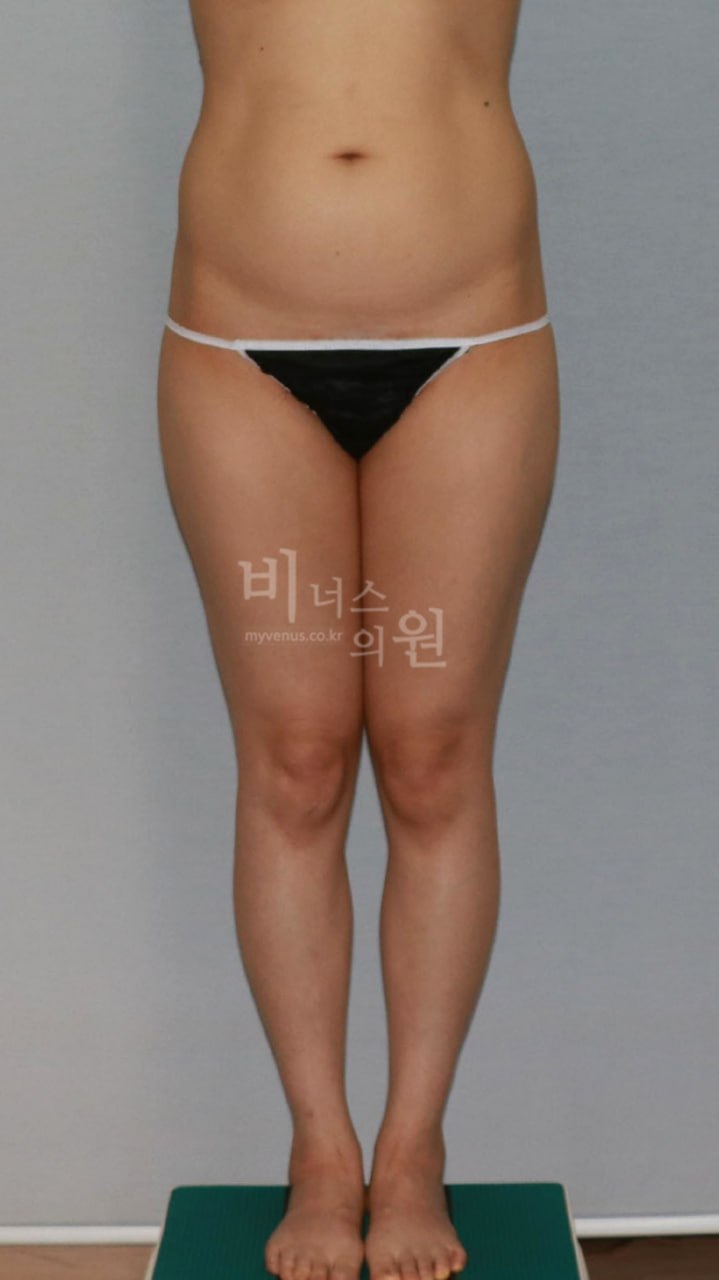 엉덩이·허벅지 지방흡입 수술 전 정면 비너스의원