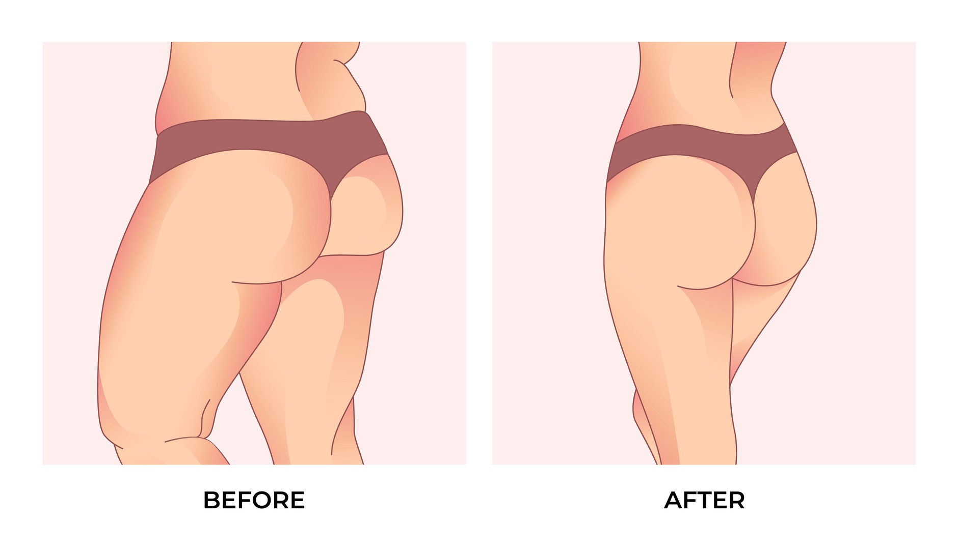 허벅지 체형 변화를 표현한 전후 비교 스톡 일러스트
