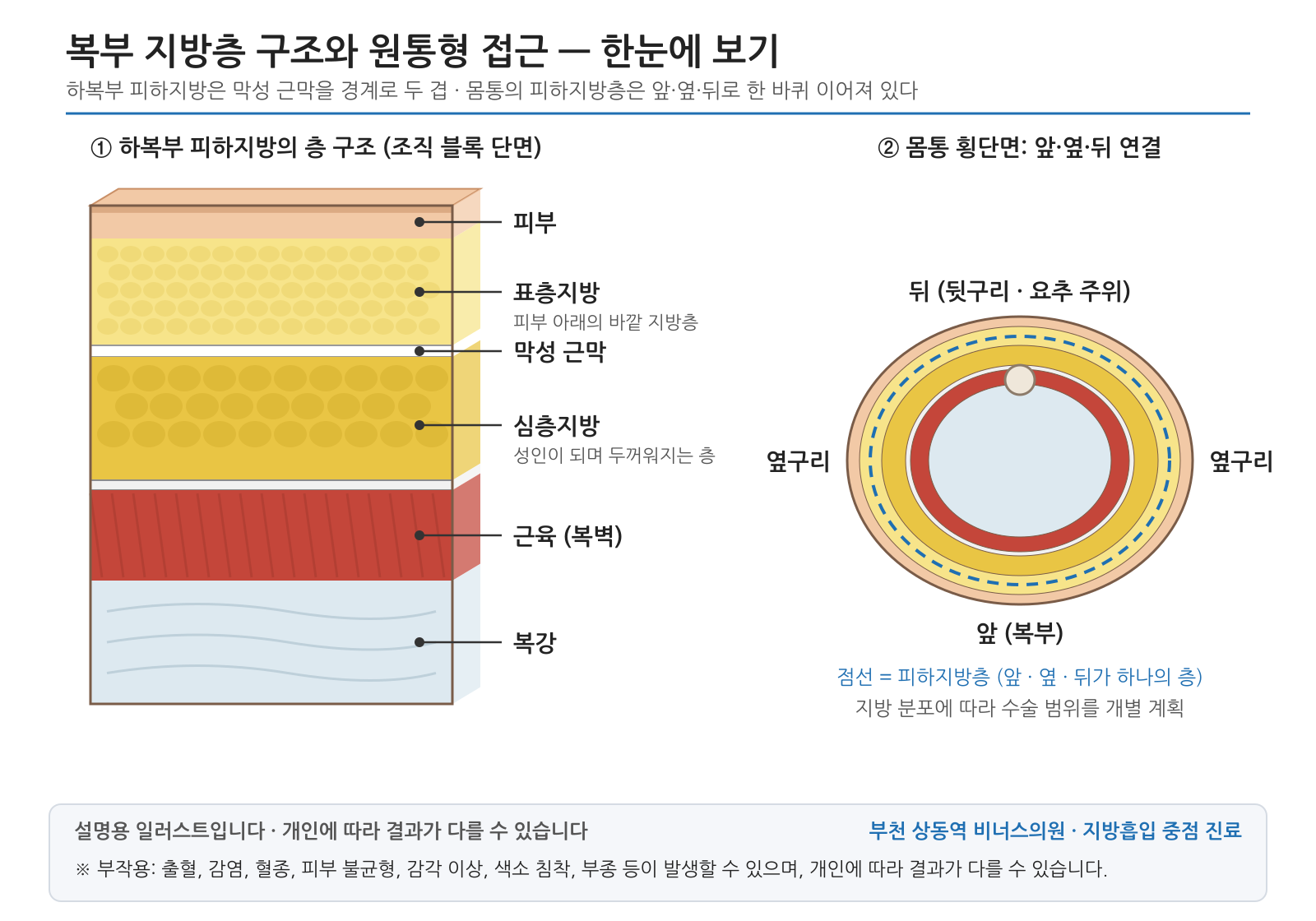 복부 지방층 구조와 원통형 접근 — 한눈에 보기 — 설명용 의학 인포그래픽