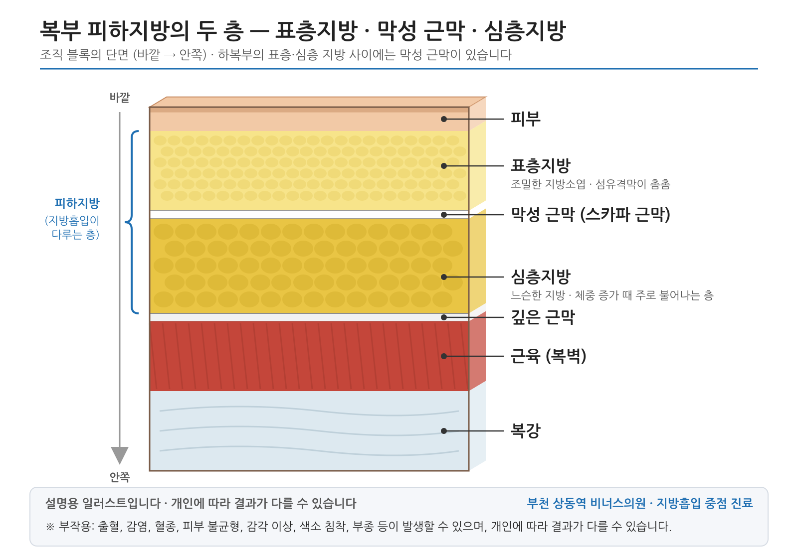 복부 피하지방의 두 층 — 표층지방 · 막성 근막 · 심층지방 — 설명용 의학 인포그래픽