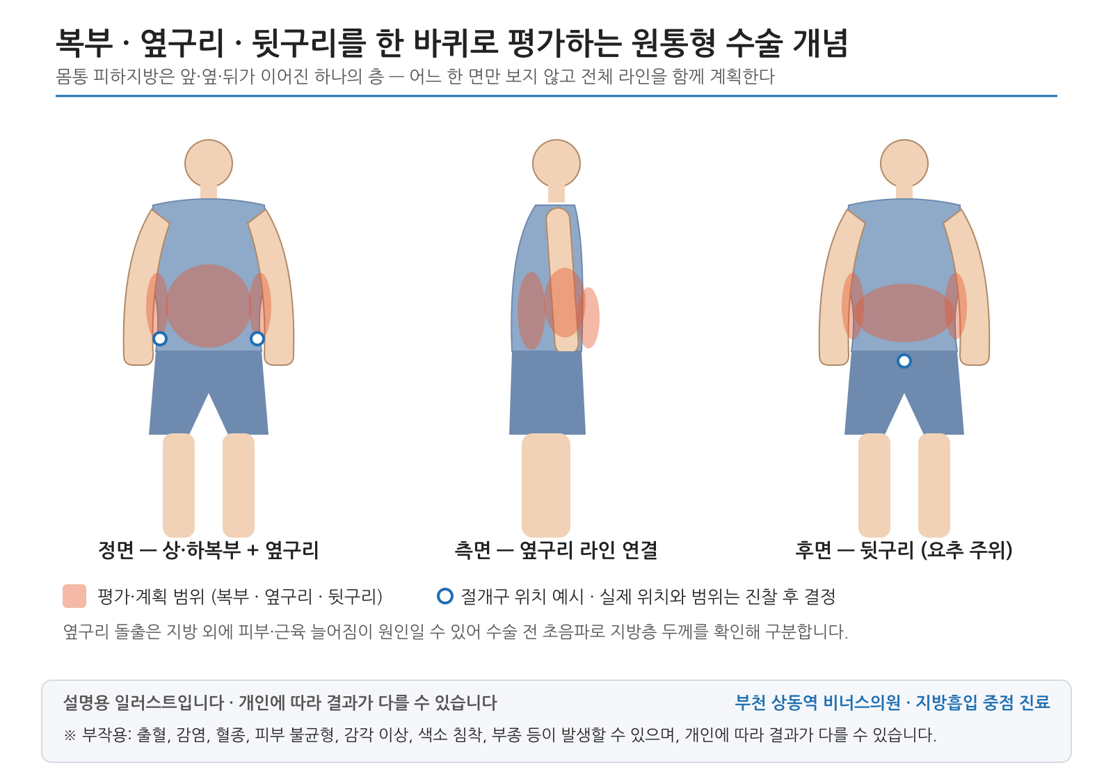 복부 · 옆구리 · 뒷구리를 한 바퀴로 평가하는 원통형 수술 개념 — 설명용 의학 인포그래픽