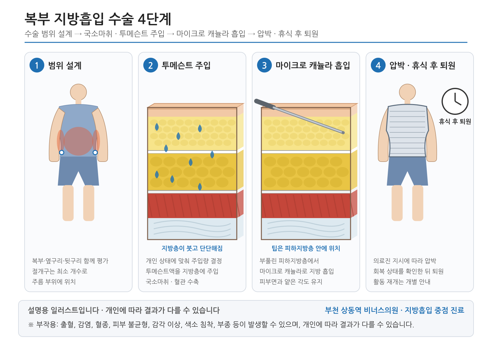 복부 지방흡입 수술 4단계 — 설명용 의학 인포그래픽