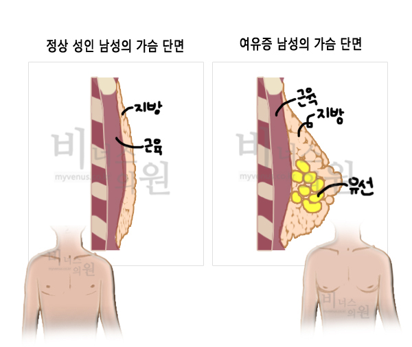 여유증9.jpg