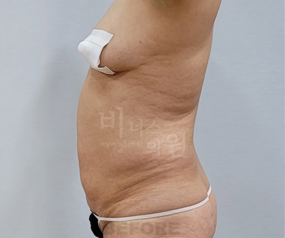 복부 지방흡입 수술 전 측면 비너스의원 — 아랫배 돌출