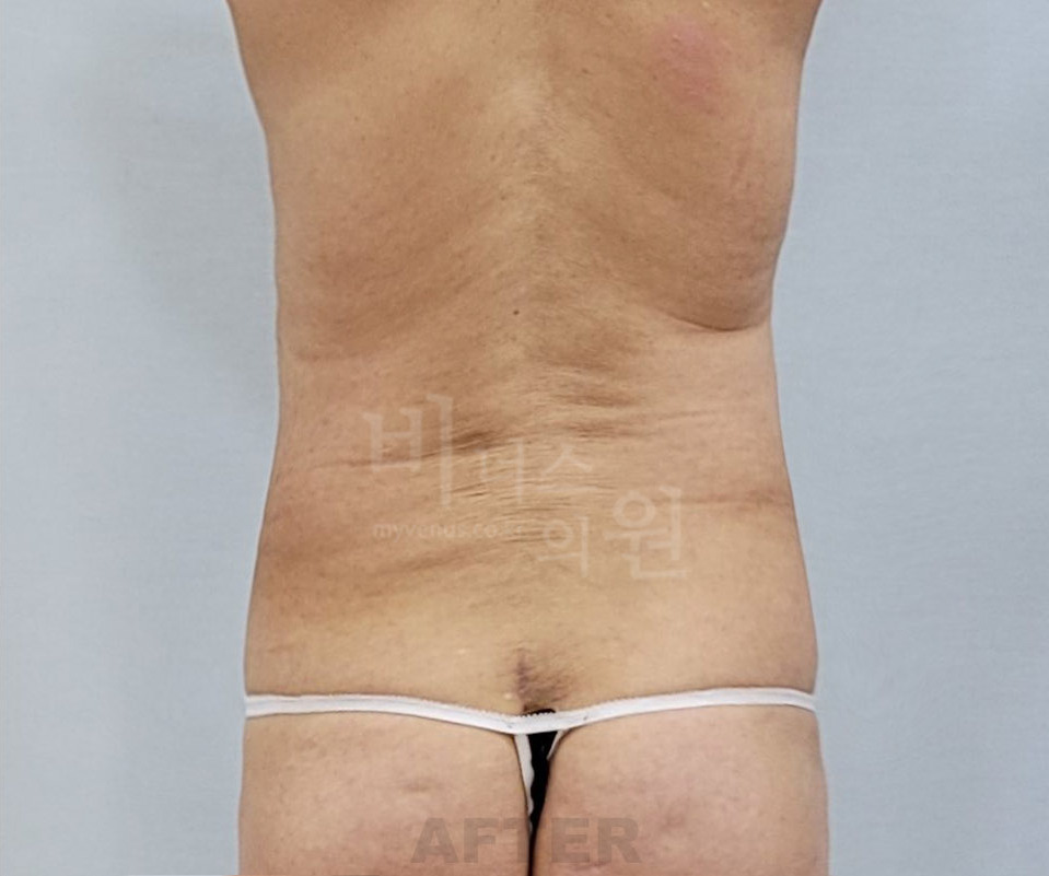복부 지방흡입 수술 후 후면 비너스의원 — 허리 뒤쪽 윤곽 정리