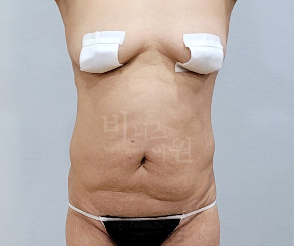 복부 지방흡입 수술 전 정면 비너스의원 — 양쪽 허리와 아랫배 윤곽