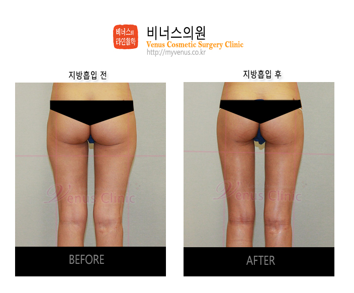 인천지방흡입 (4).jpg