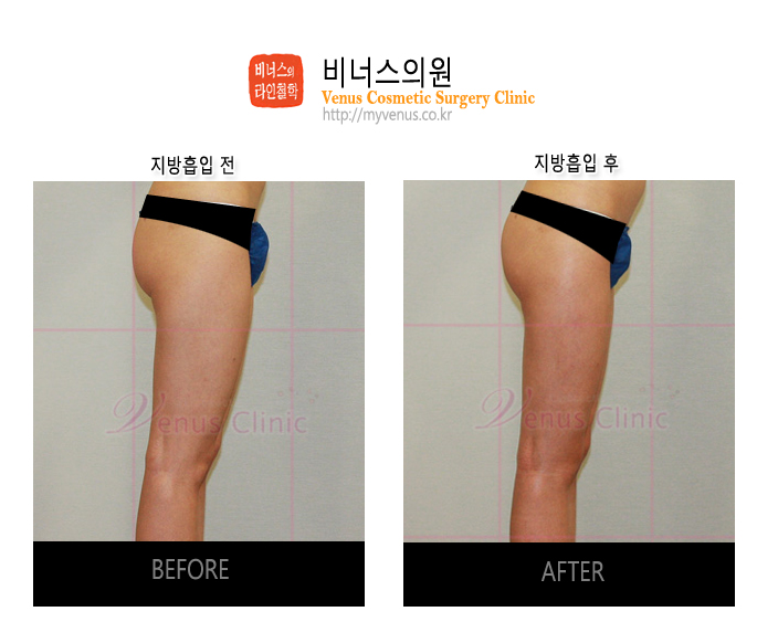 인천지방흡입 (3).jpg