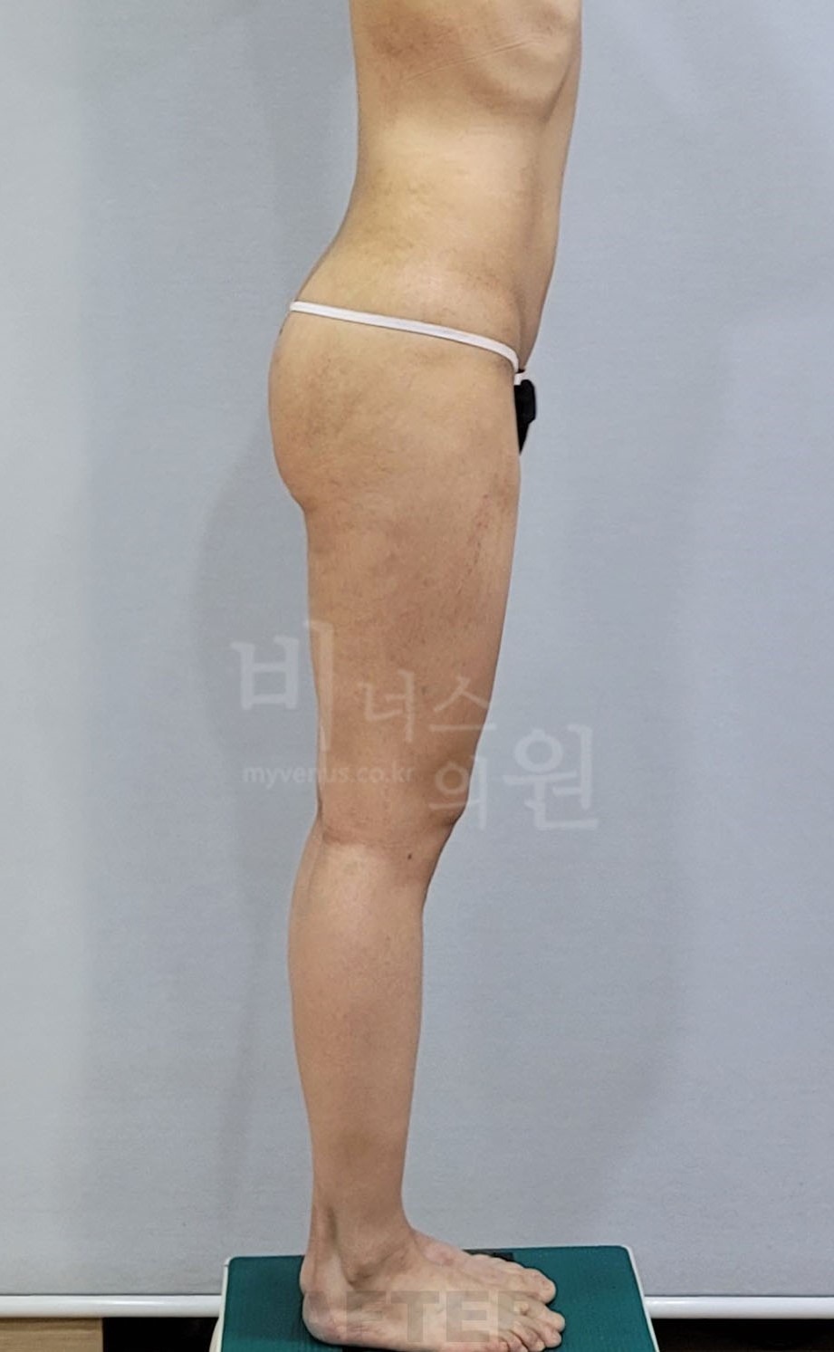 엉덩이축소 지방흡입 수술 후 좌측면 엉덩이 이중주름 비너스의원