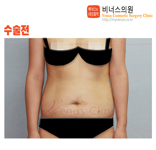 복부지방흡입.gif