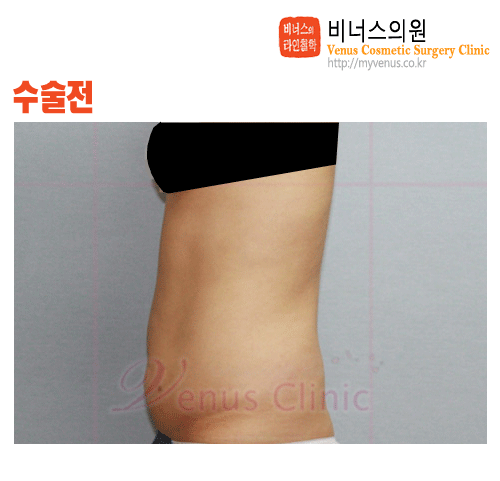 복부지방흡입2.gif