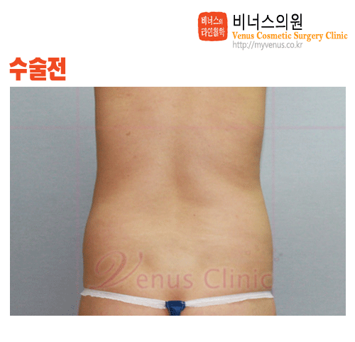 복부지방흡입4.gif