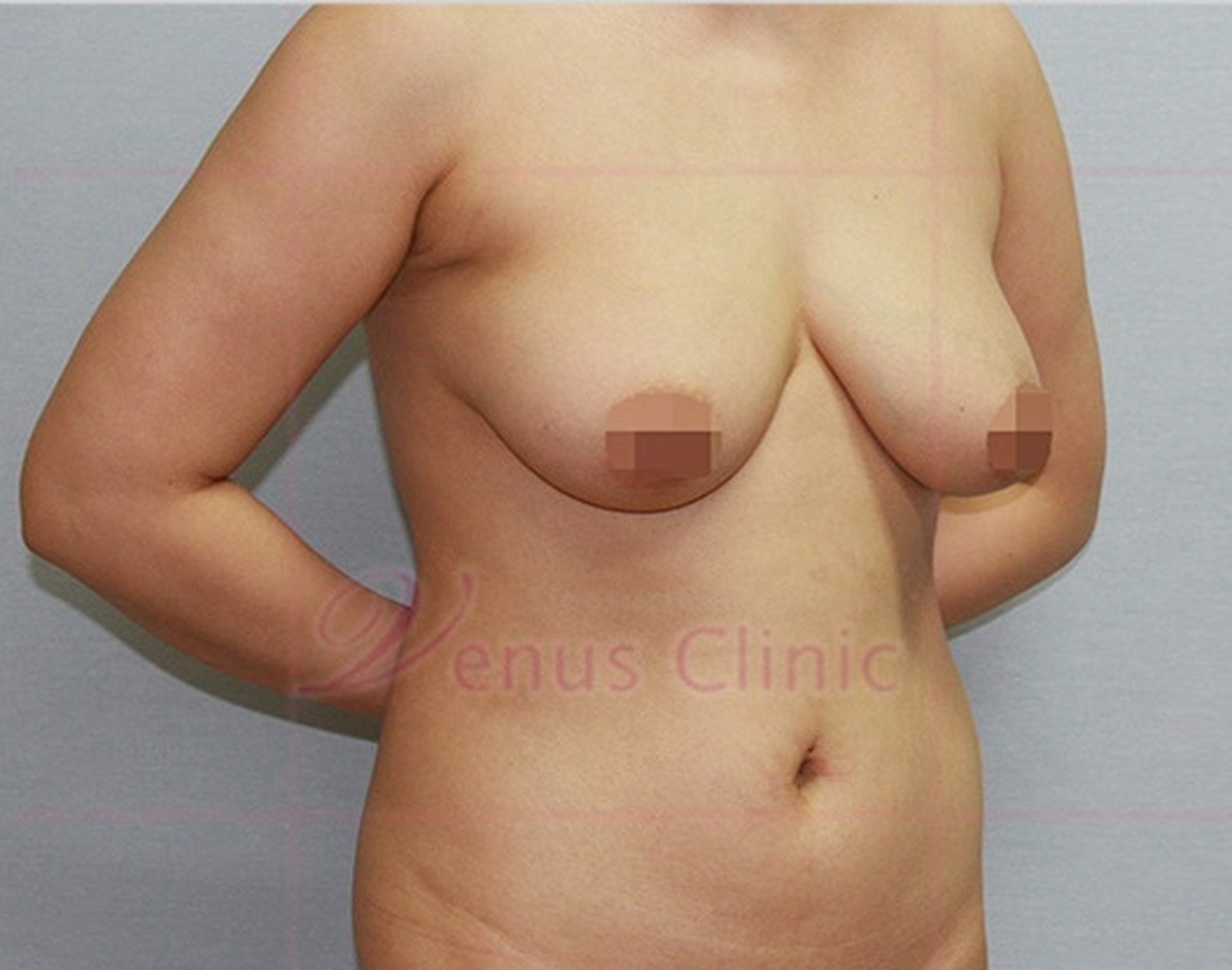 가슴축소 지방흡입 수술 전 측면 모습