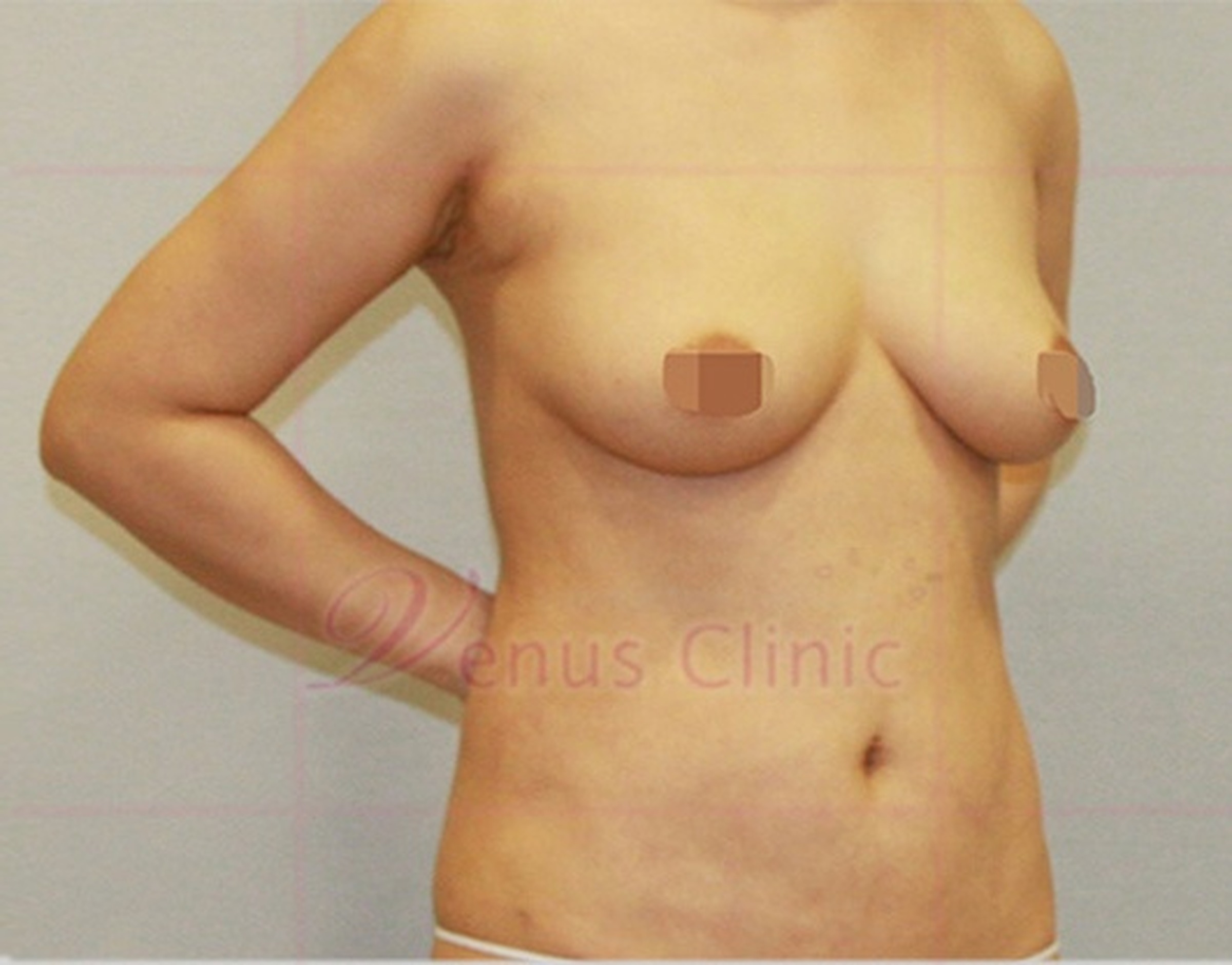 가슴축소 지방흡입 수술 후 측면 모습