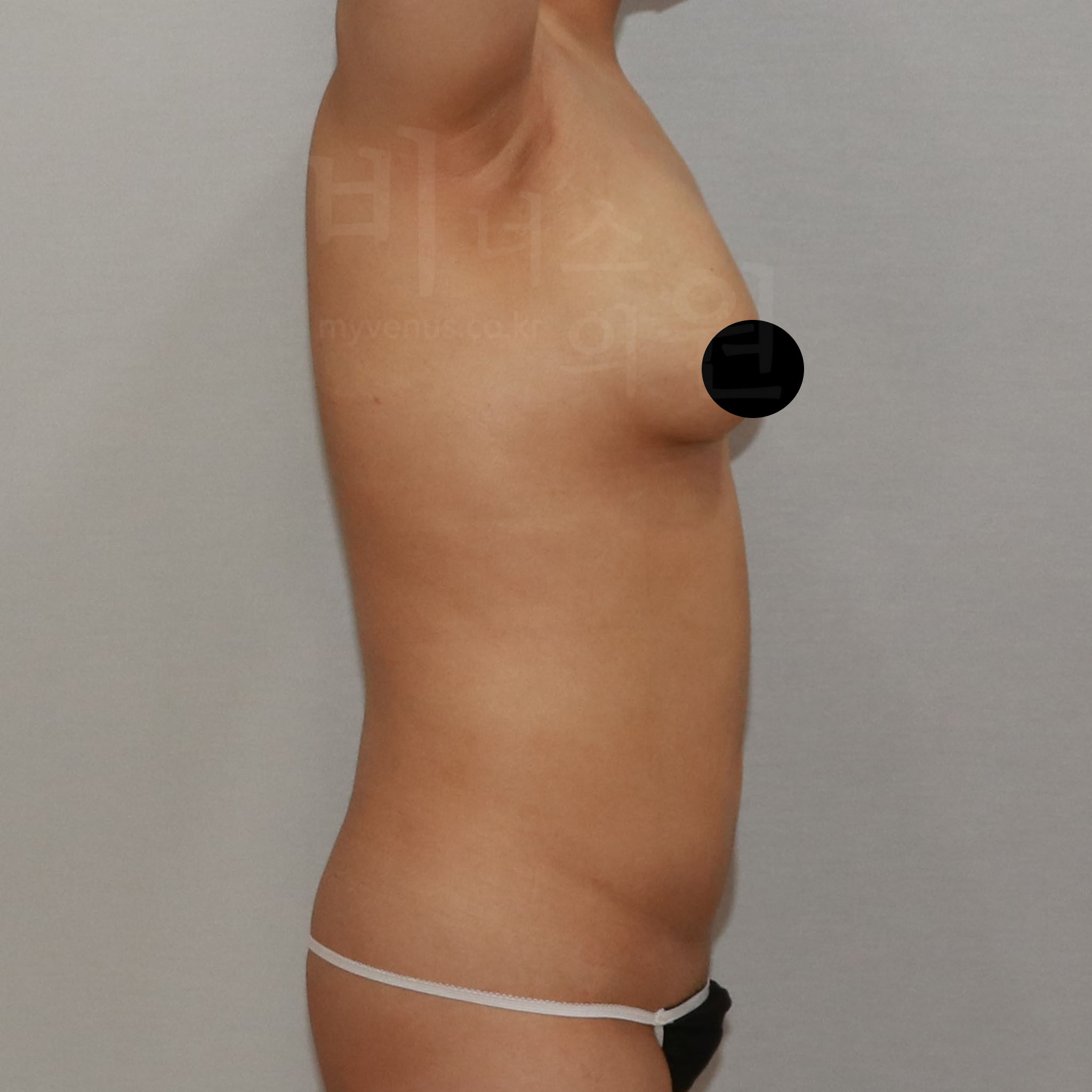 가슴축소 지방흡입 수술 후 우측면 모습 CASE B