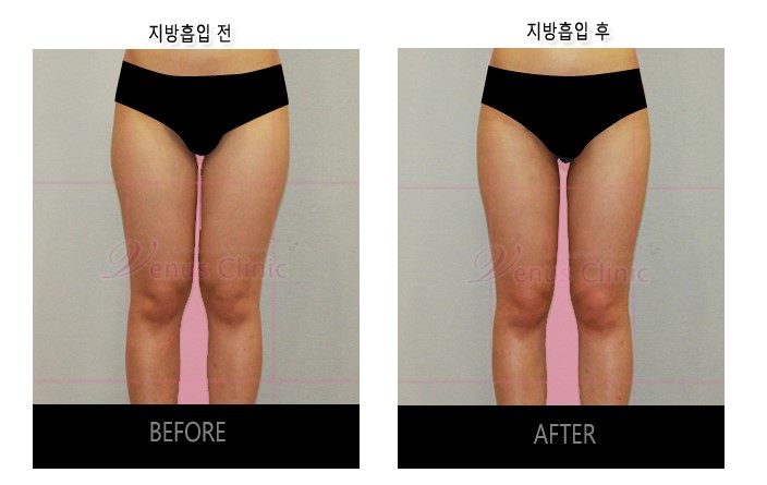 지방흡입1.jpg