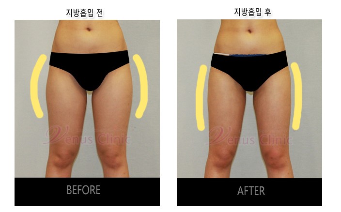 지방흡입2.jpg