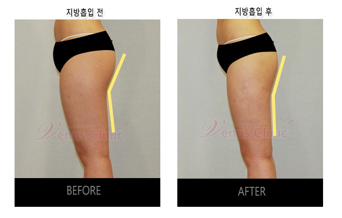 지방흡입5.jpg