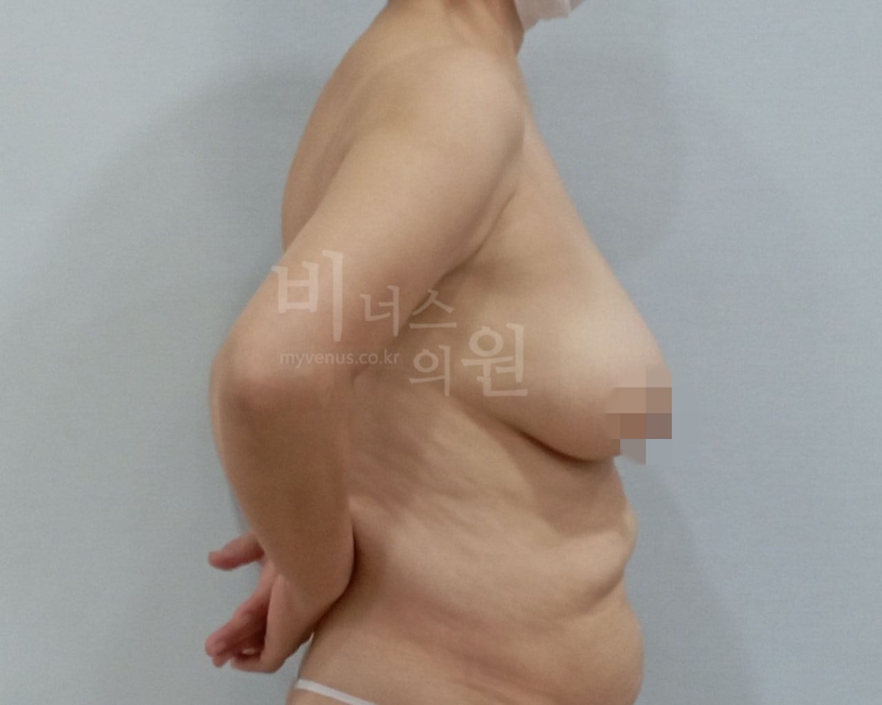 가슴축소 지방흡입 수술 전 비너스의원