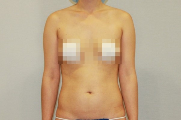 뱃살 옆구리 복부 러브핸들 러브핸들 지방흡입.jpg