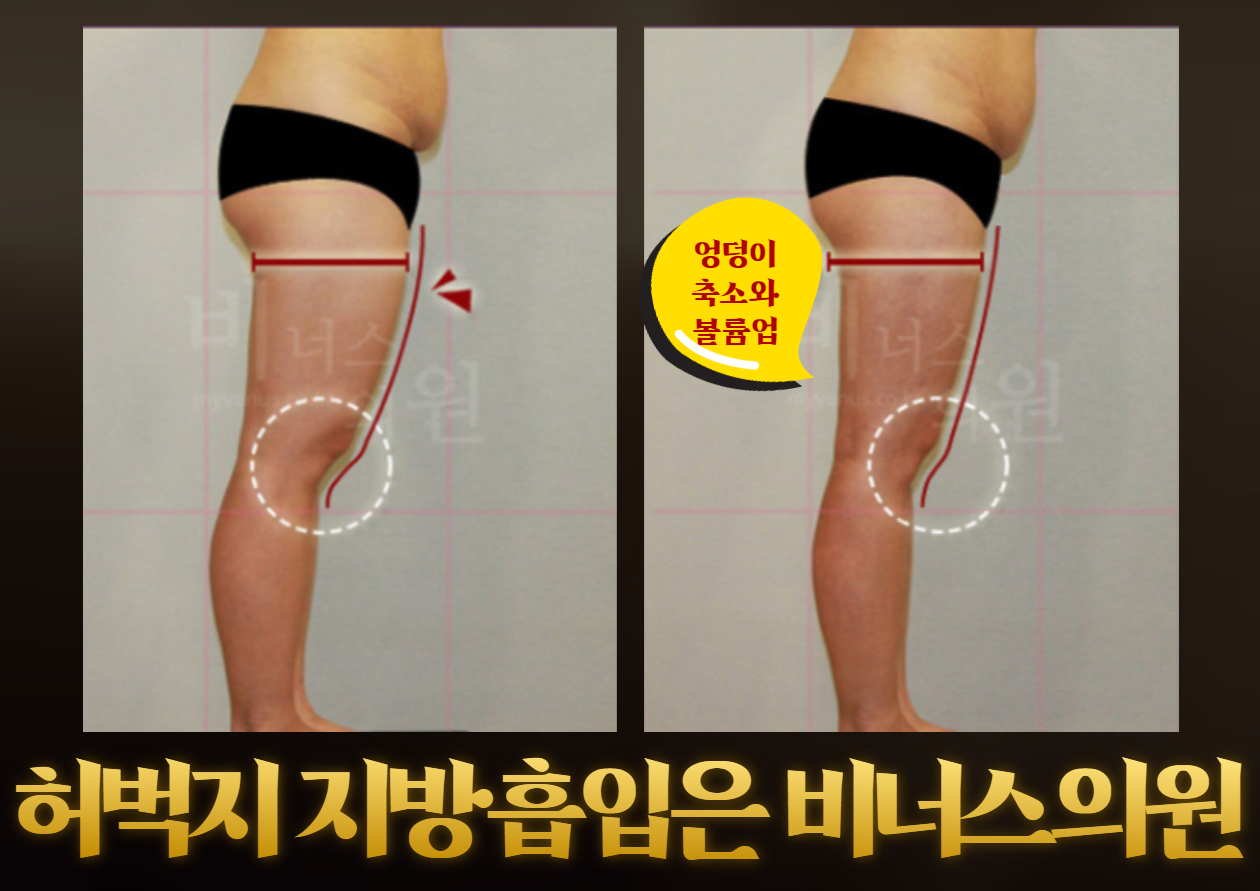 허엉 지방흡입 (3).jpg