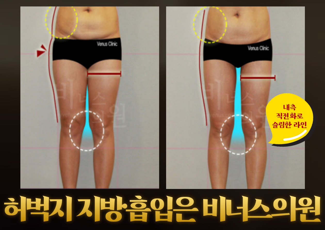 허엉 지방흡입 (4).jpg