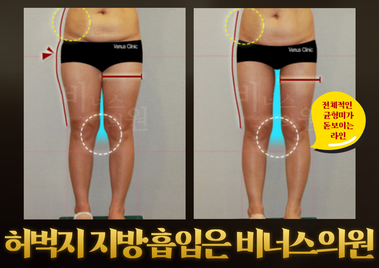 허엉 지방흡입 (1).jpg