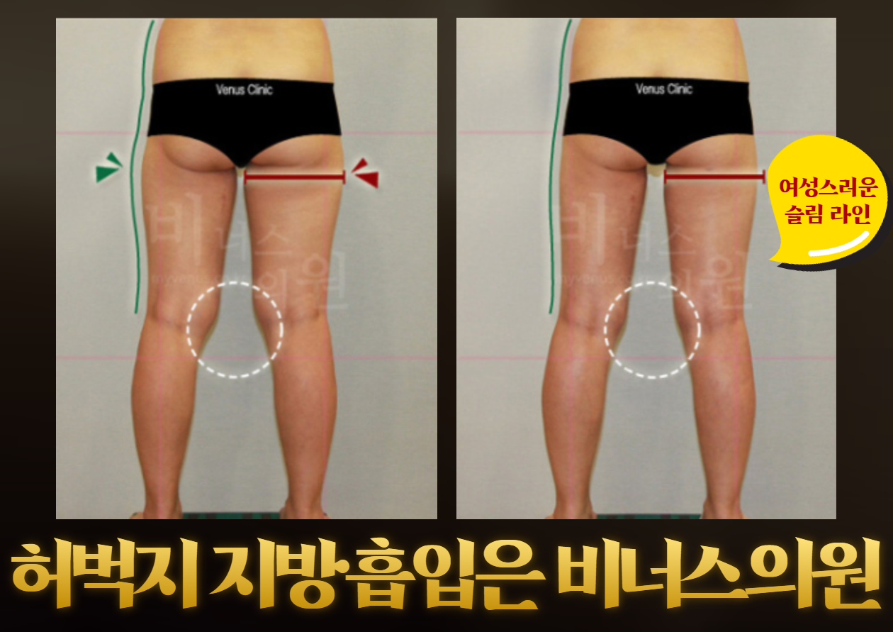 허엉 지방흡입 (2).jpg