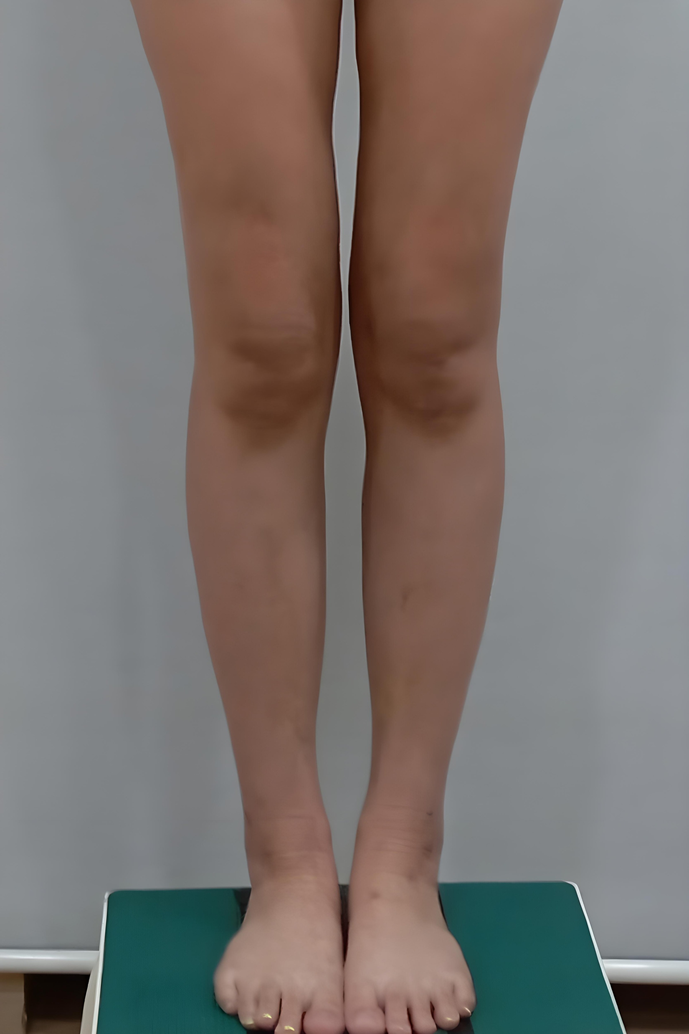 종아리 지방흡입 수술 전 정면 비너스의원