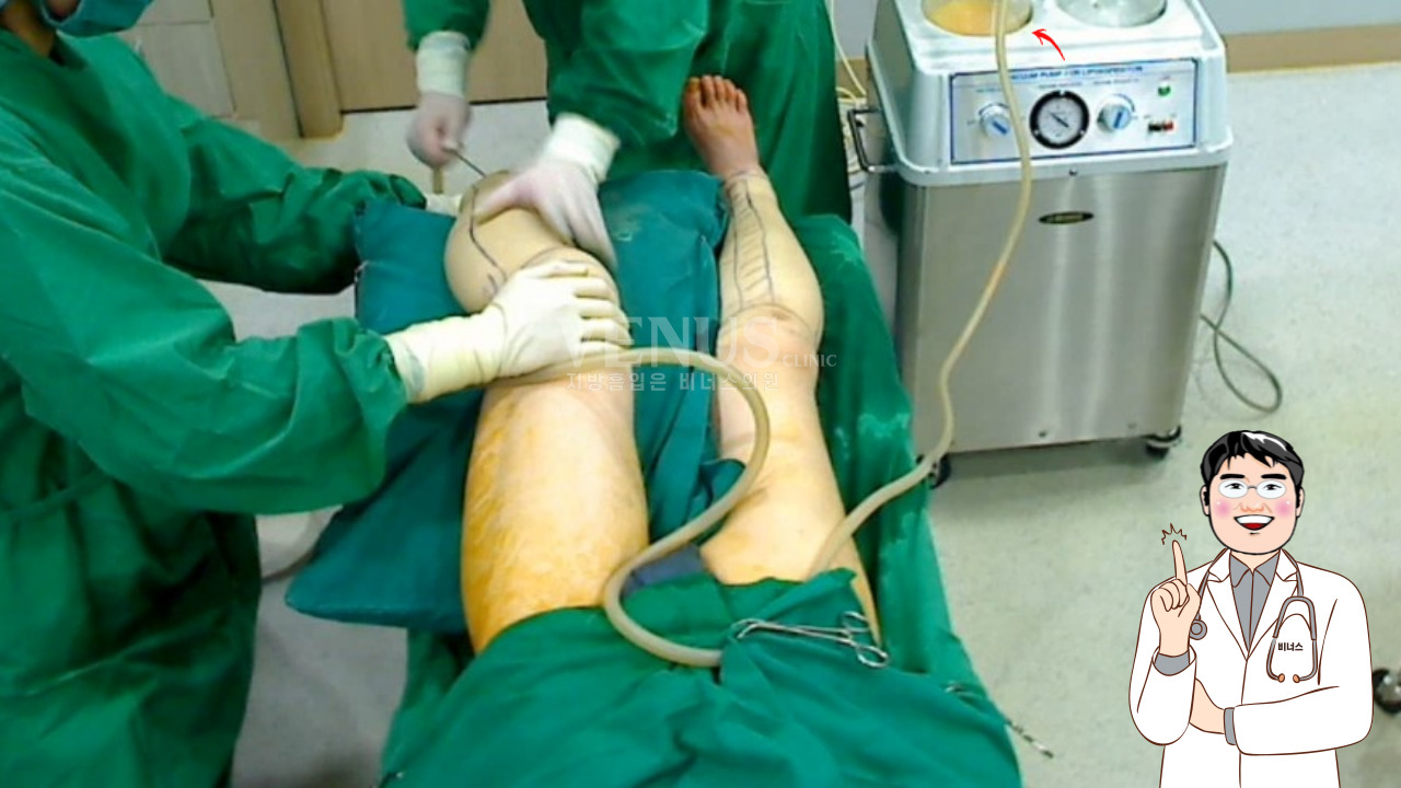 종아리 지방흡입 수술 과정 캐뉼라 시술 장면 비너스의원