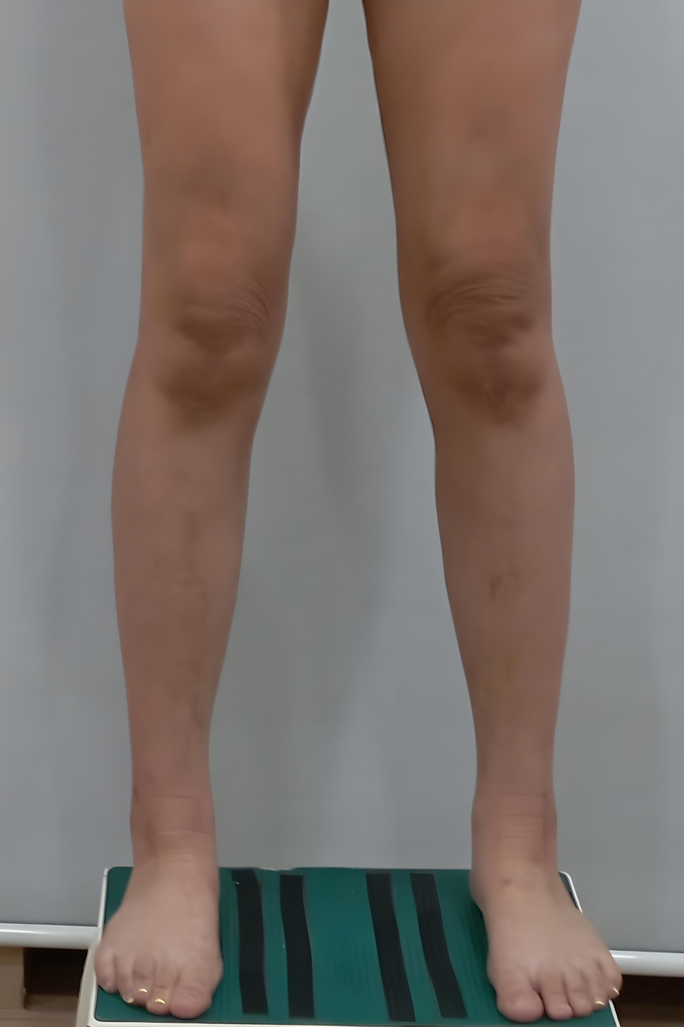 종아리 지방흡입 수술 후 정면 비너스의원