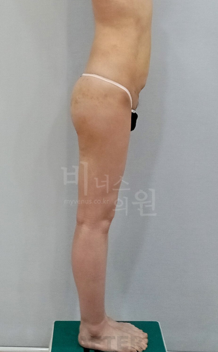 엉덩이 지방흡입 수술 후 좌측면 비너스의원