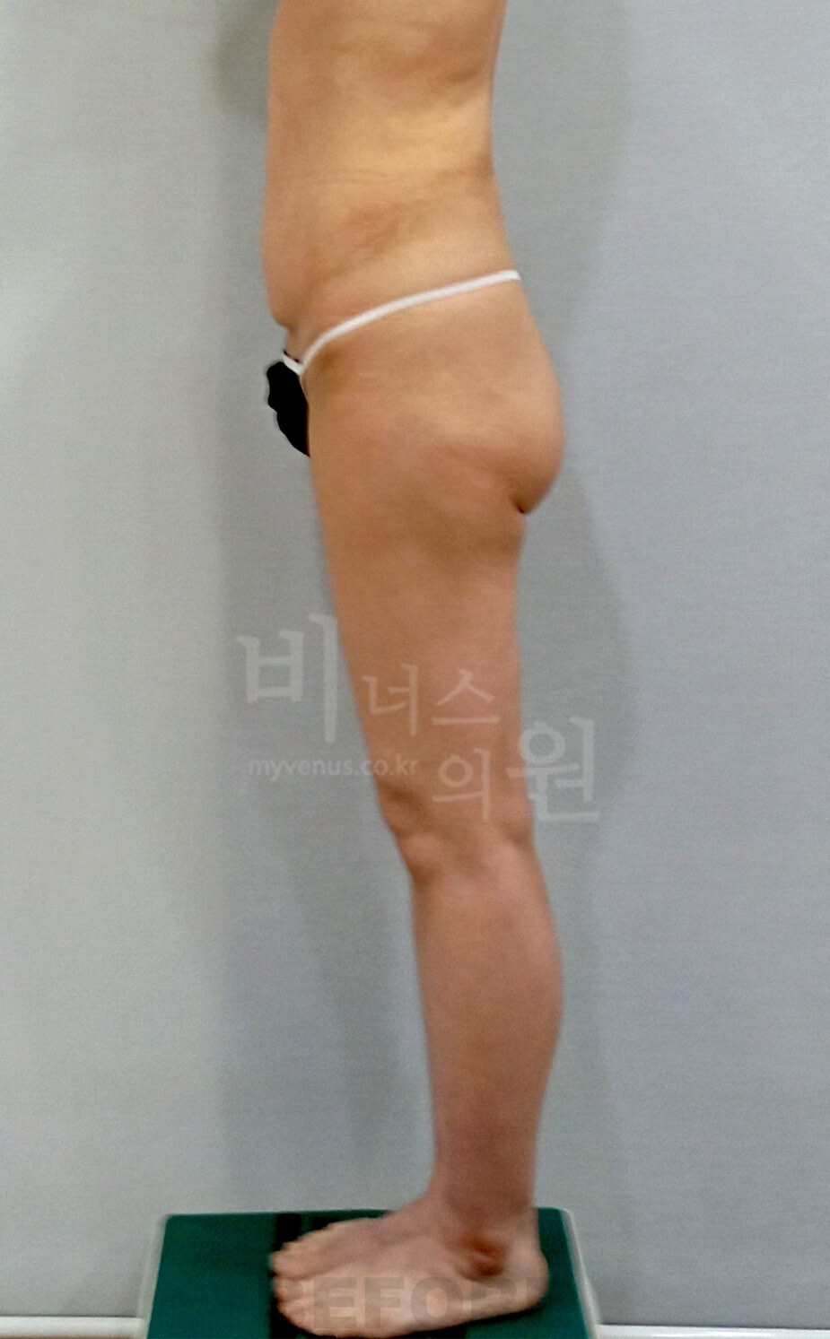 엉덩이 지방흡입 수술 전 우측면 비너스의원