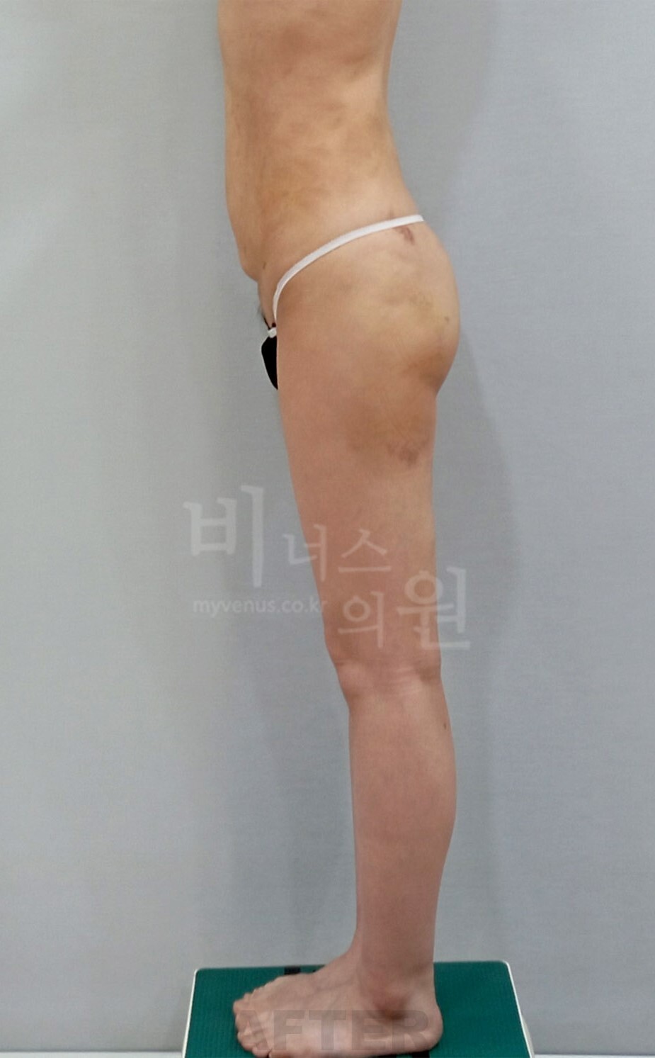 엉덩이 지방흡입 수술 후 우측면 비너스의원