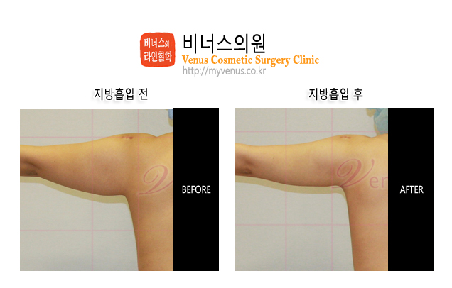 팔지방흡입03.jpg