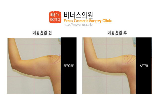 팔지방흡입01.jpg