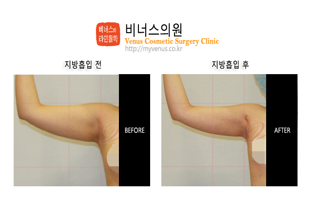 팔지방흡입0.jpg