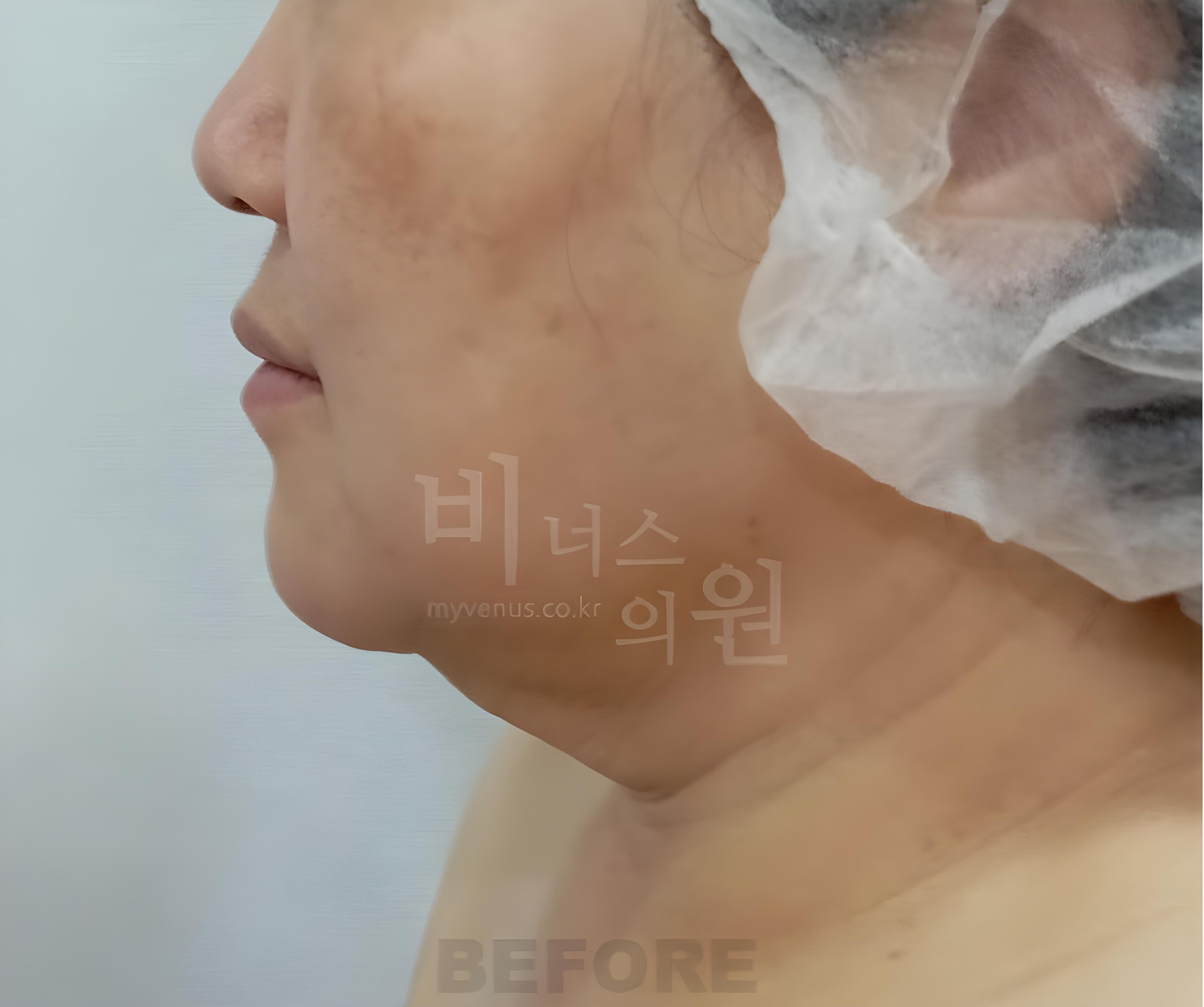 이중턱 턱라인 지방흡입 수술 전 측면 비너스의원