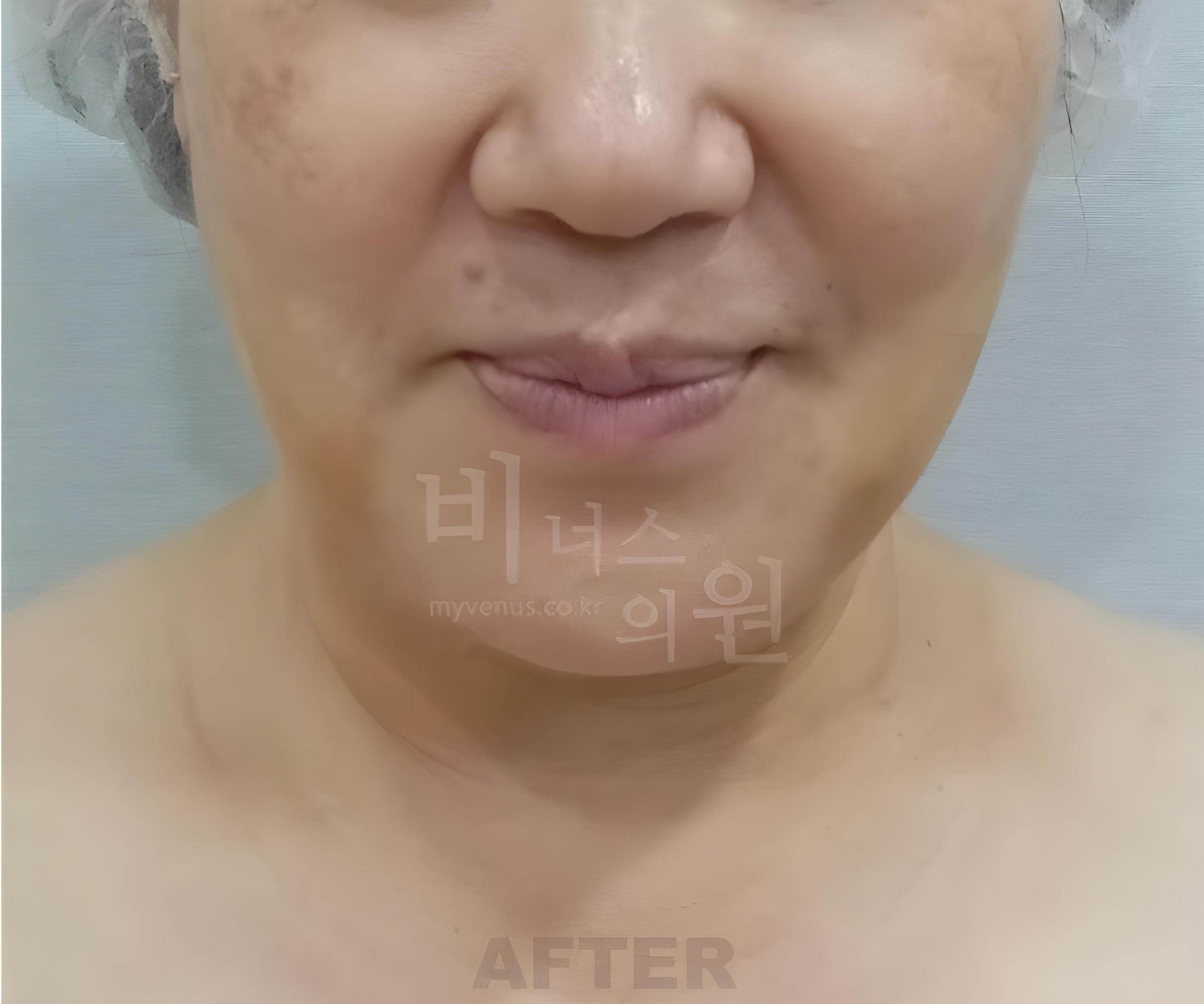 이중턱 턱라인 지방흡입 수술 후 정면 비너스의원