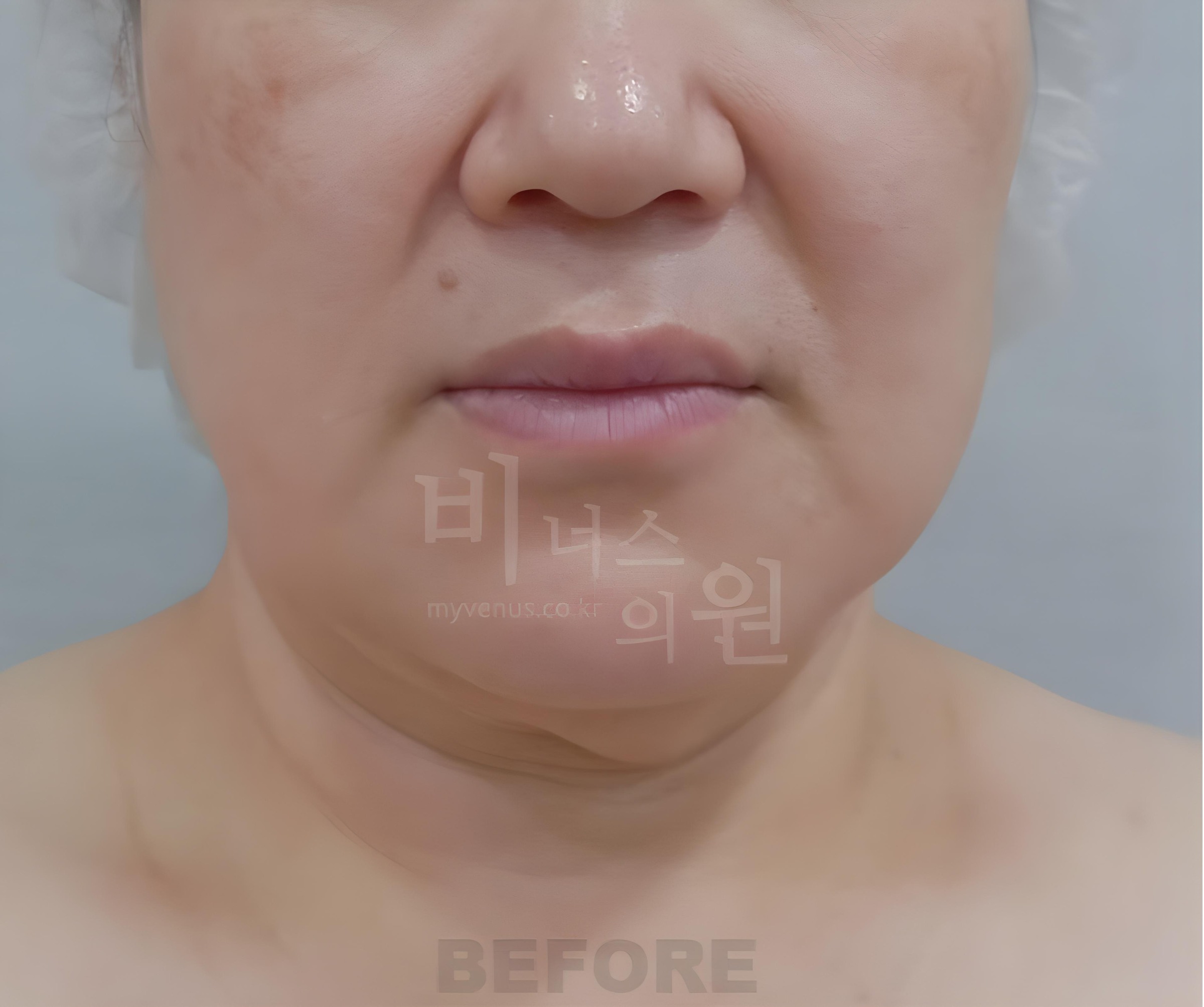 이중턱 턱라인 지방흡입 수술 전 정면 비너스의원
