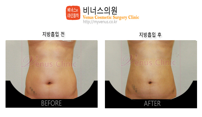 지방흡입 (4).jpg