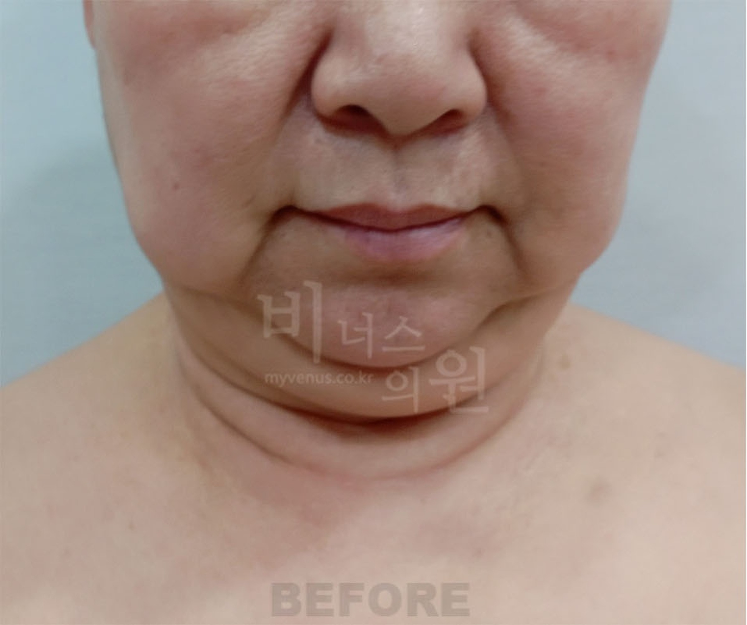 이중턱 지방흡입 수술 전 정면