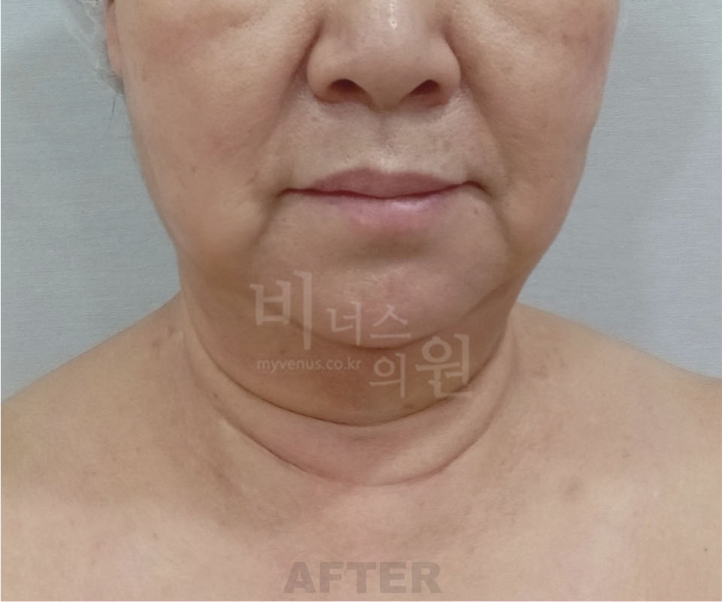 이중턱 지방흡입 수술 후 정면