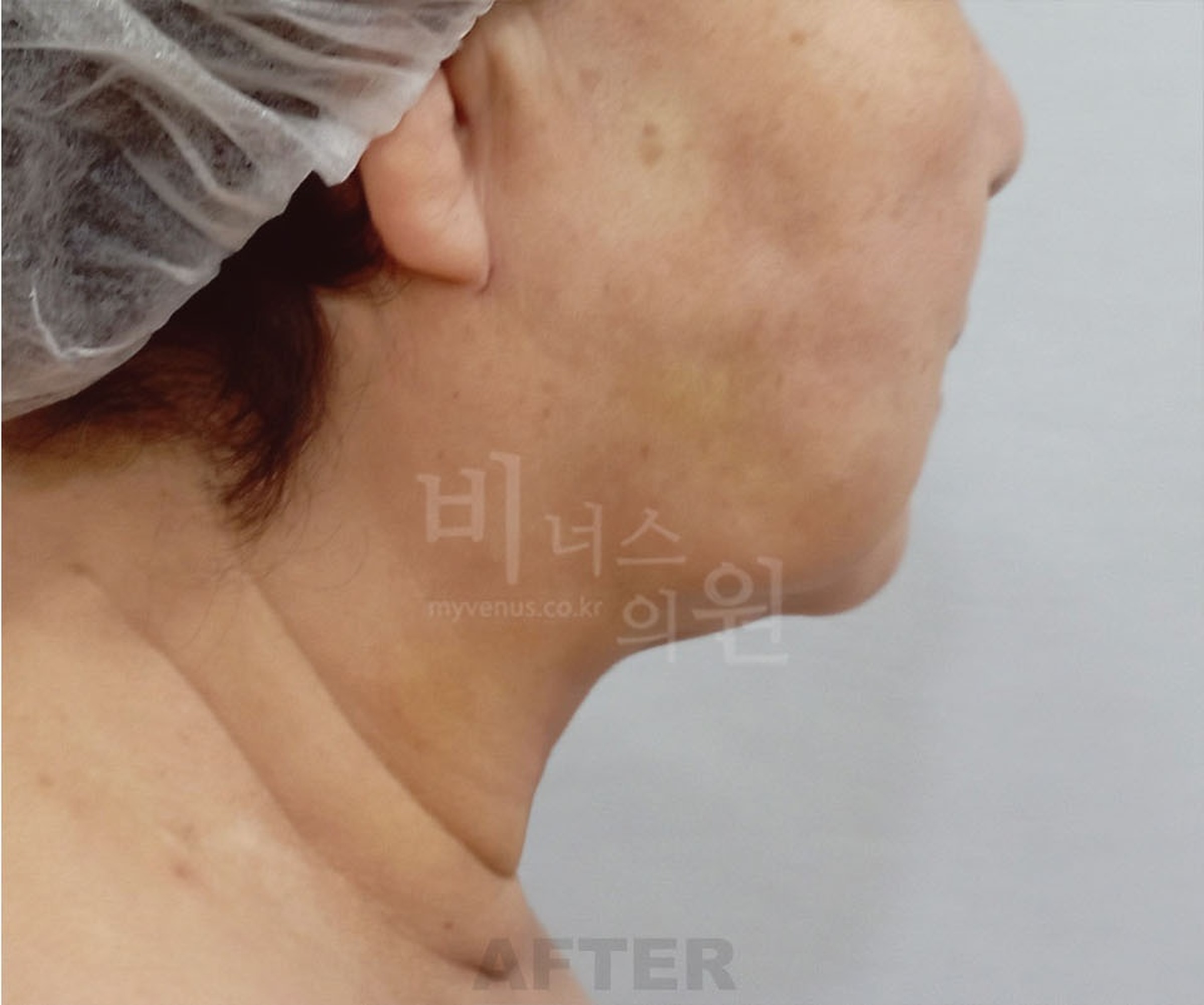 이중턱 지방흡입 수술 후 좌측면