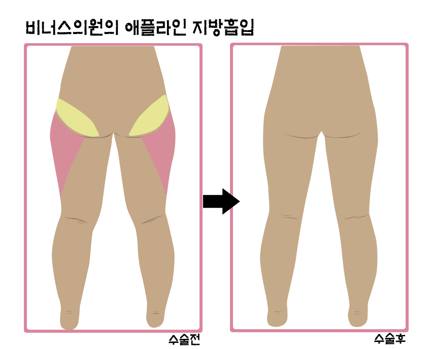 부분지방흡입2.gif