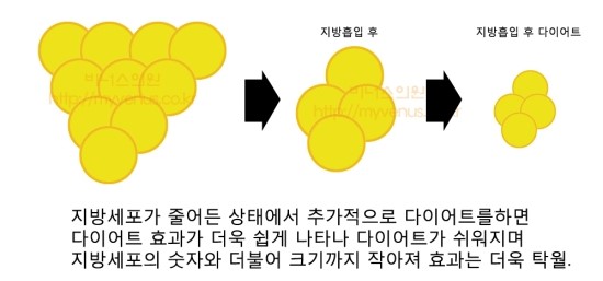 부분지방흡입3.JPG
